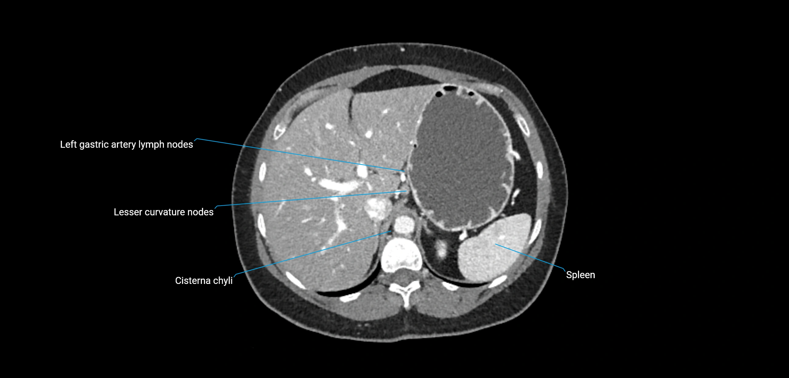CT ct abdominal lymph nodes  axial cross sectional anatomy  enchanced radiology image -img-00002-00121.webp